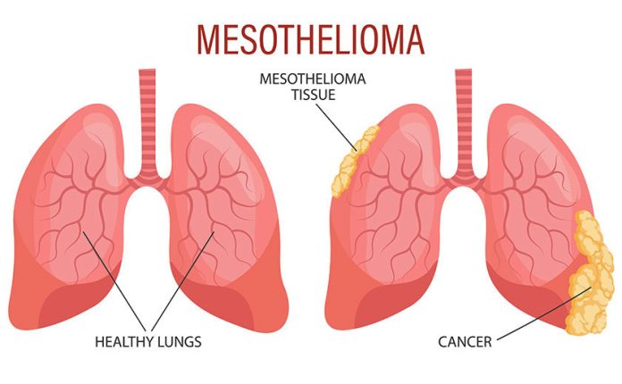 Mesothelioma Attorney Specialized: How to Secure Your M+ Settlement in 2026